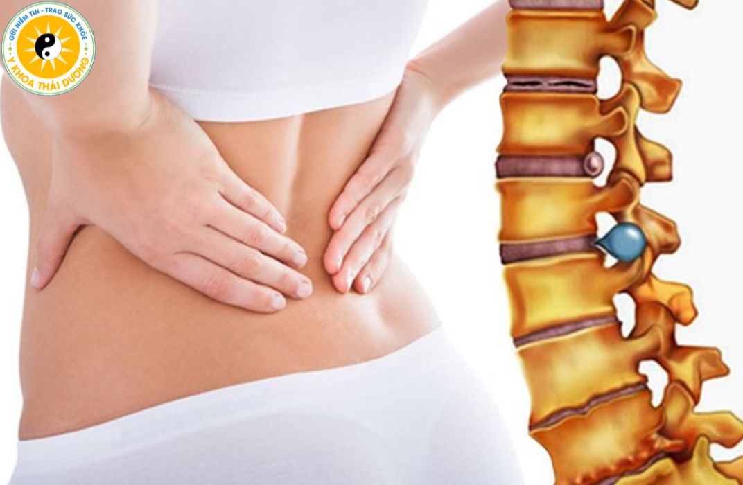Thoát vị đĩa đệm: Triệu chứng, nguyên nhân và giải pháp điều trị không phẫu thuật
