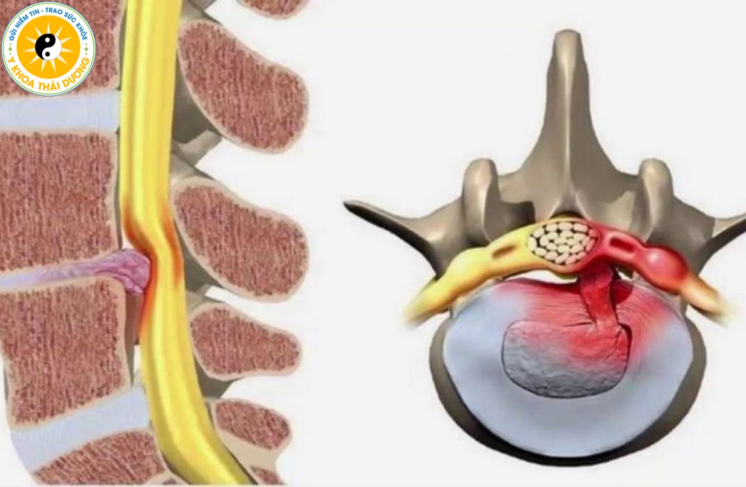 Thoát vị đĩa đệm có chữa dứt điểm được không?