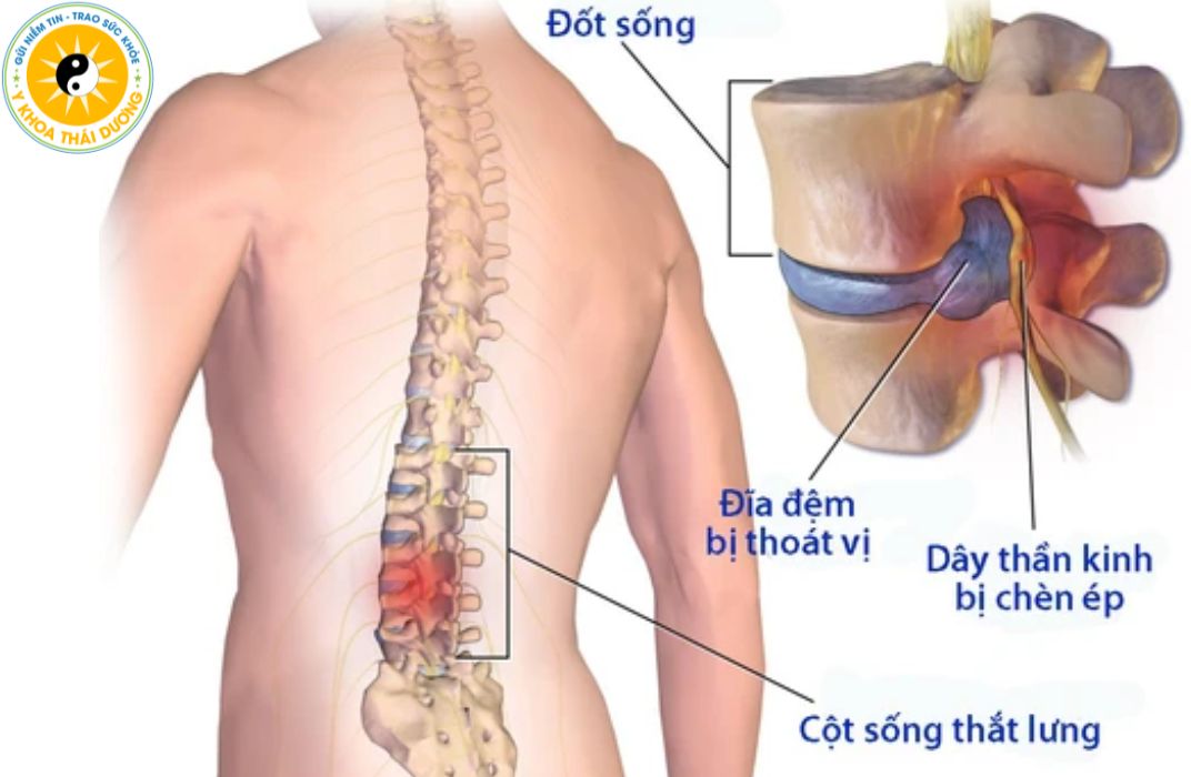 Thoát vị đĩa đệm có chữa dứt điểm được không?