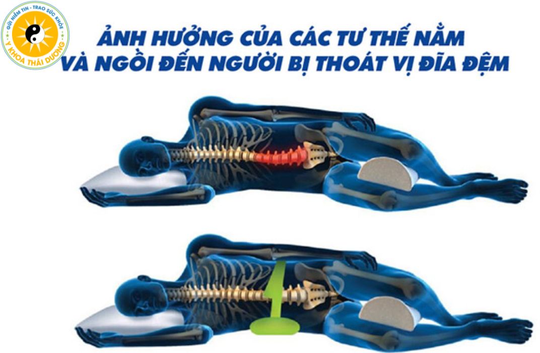 Thoát vị đĩa đệm: Nằm nhiều có tốt không và cách phòng ngừa biến chứng