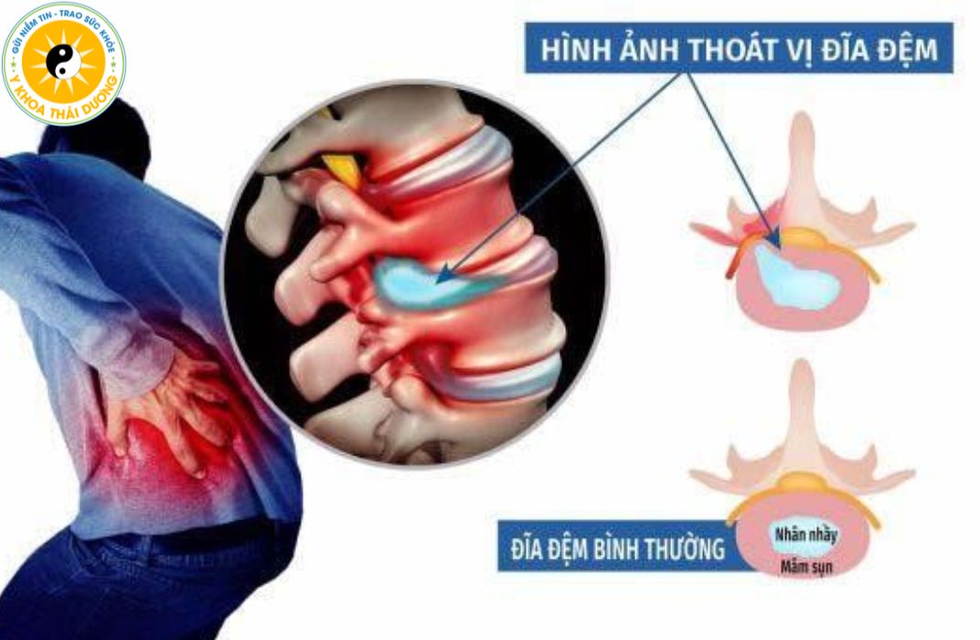 Thoát vị đĩa đệm