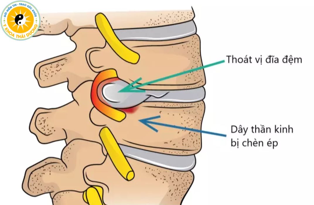 Thoát vị đĩa đệm: Triệu chứng, nguyên nhân và giải pháp điều trị không phẫu thuật