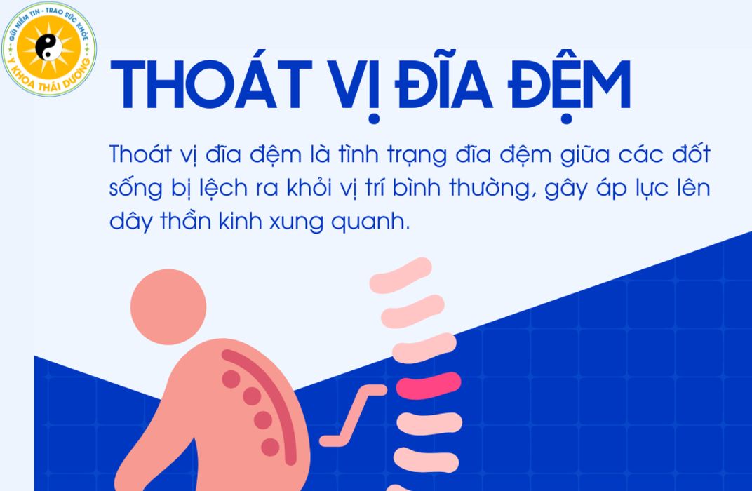 Thoát vị đĩa đệm: Triệu chứng, nguyên nhân và giải pháp điều trị không phẫu thuật