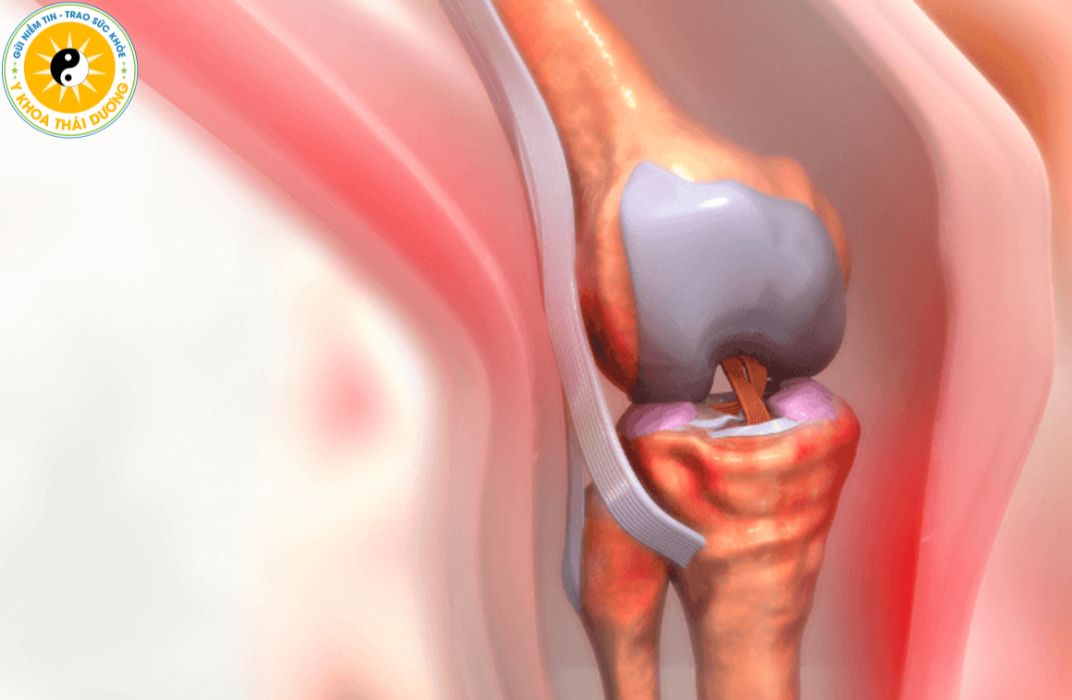 Tràn dịch khớp gối là gì? Dấu hiệu nhận biết sớm và mức độ nguy hiểm