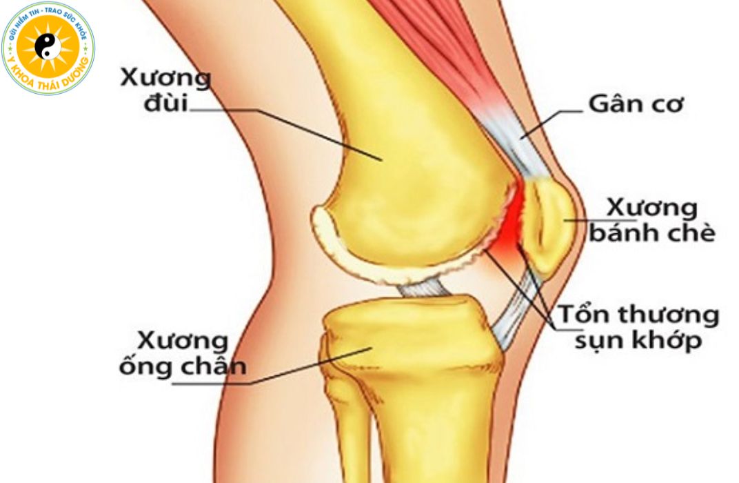 Tràn dịch khớp gối là gì? Dấu hiệu nhận biết sớm và mức độ nguy hiểm