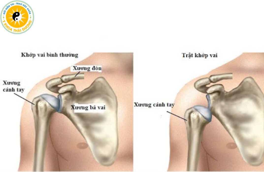 Trật khớp vai: Nhận biết triệu chứng và cách phòng ngừa an toàn