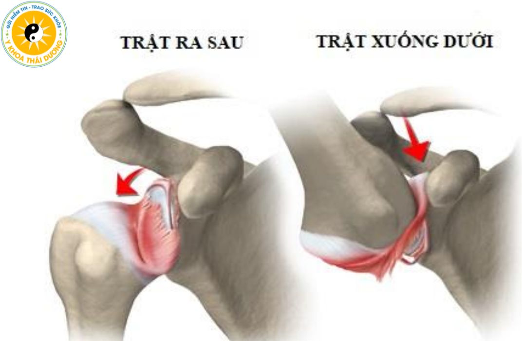 Trật khớp vai: Nhận biết triệu chứng và cách phòng ngừa an toàn