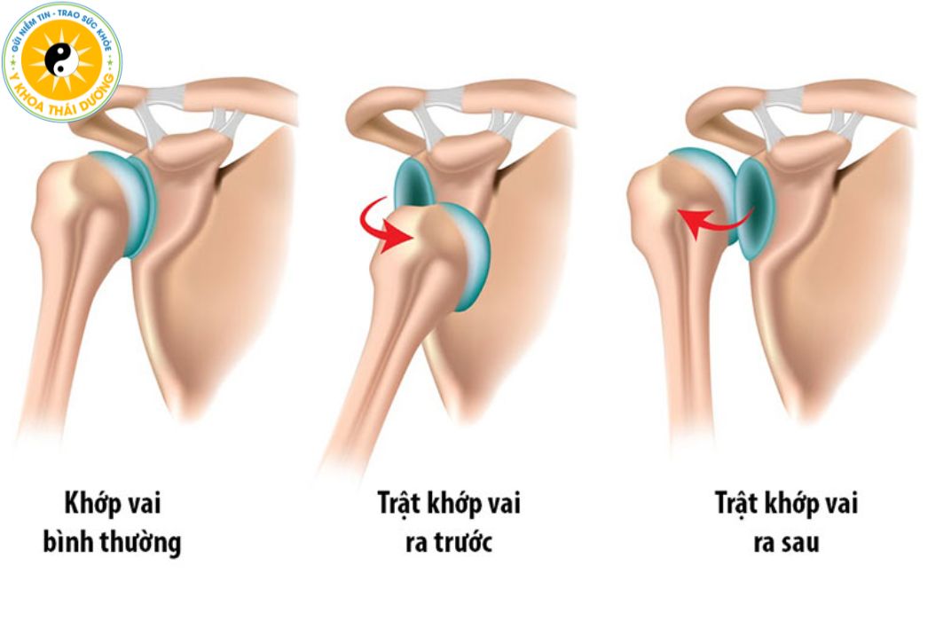 Trật khớp vai: Nhận biết triệu chứng và cách phòng ngừa an toàn