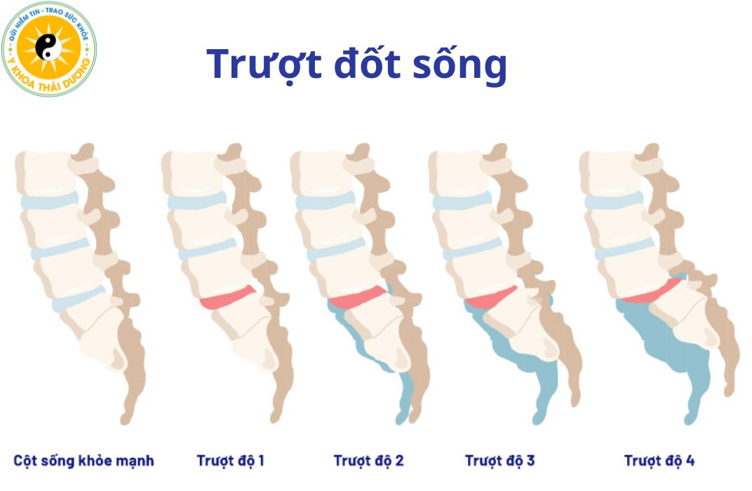 Trượt đốt sống: Nhận biết và điều trị phục hồi đúng cách