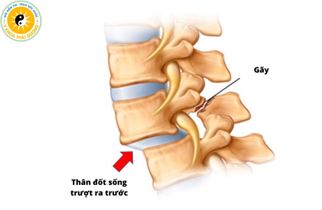 Trượt đốt sống: Nhận biết và điều trị phục hồi đúng cách