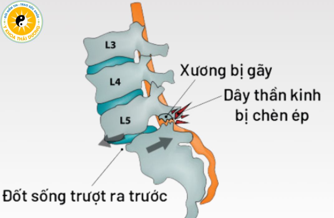 Trượt đốt sống: Nhận biết và điều trị phục hồi đúng cách