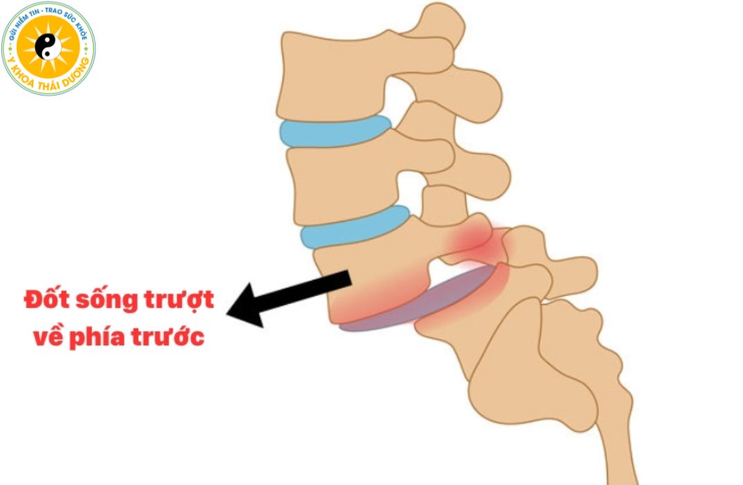 Trượt đốt sống: Nhận biết và điều trị phục hồi đúng cách