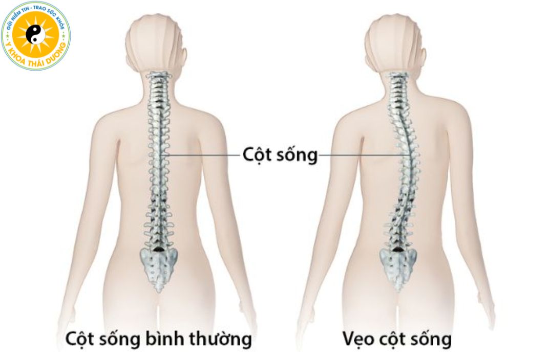 Đau thần kinh tọa