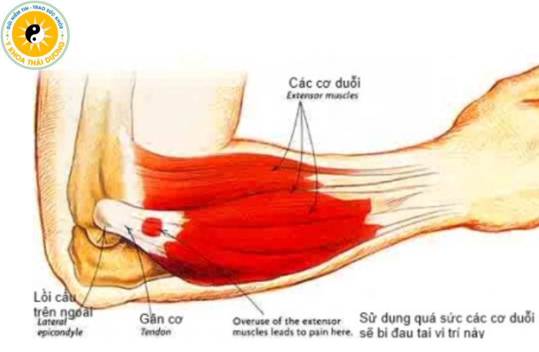 Viêm cơ: Khi nào cần điều trị bằng vật lý trị liệu?