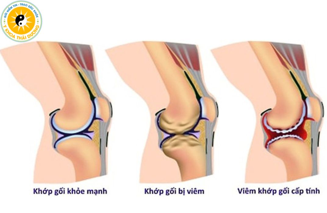 Viêm đau khớp gối mạn tính: Giải pháp điều trị không phẫu thuật hiệu quả
