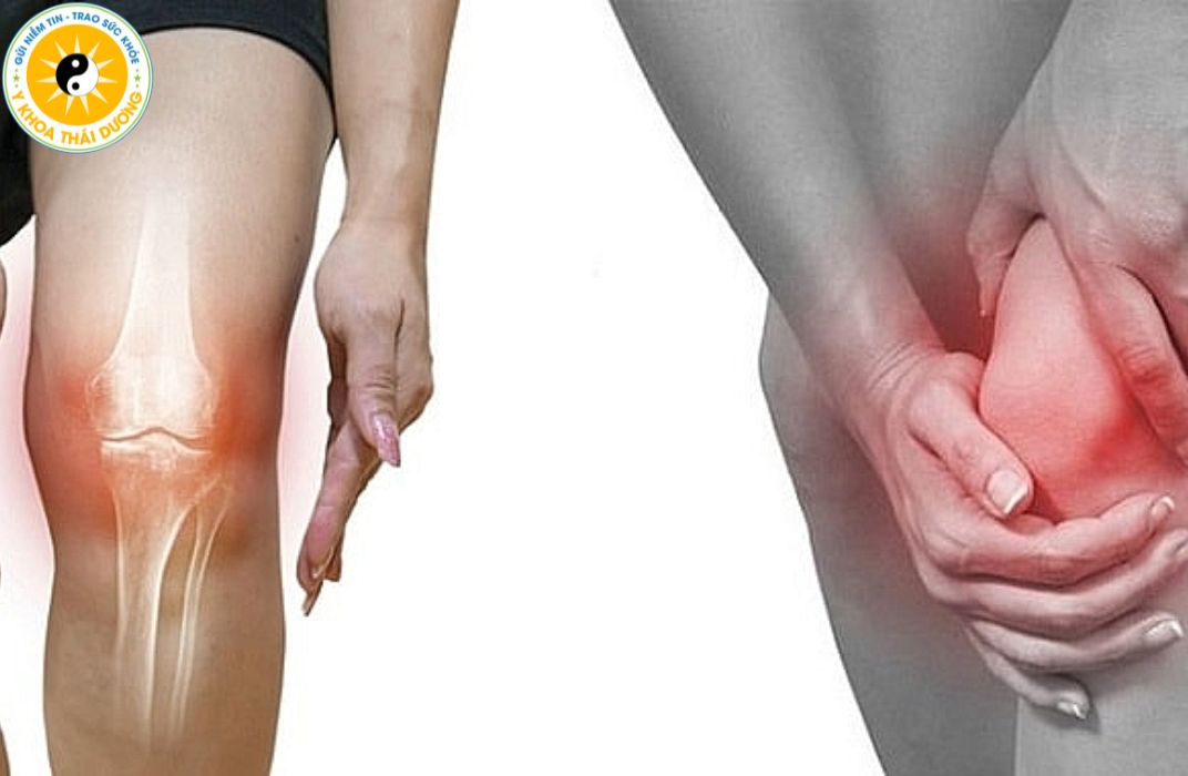 Viêm đau khớp gối ở người già: Dấu hiệu nhận biết sớm và cách điều trị đúng