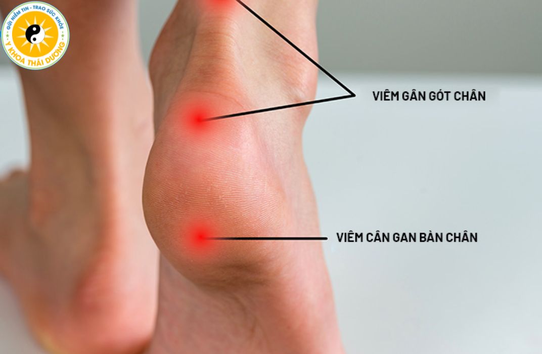 Viêm gân: Làm sao để điều trị dứt điểm và tránh tái phát?