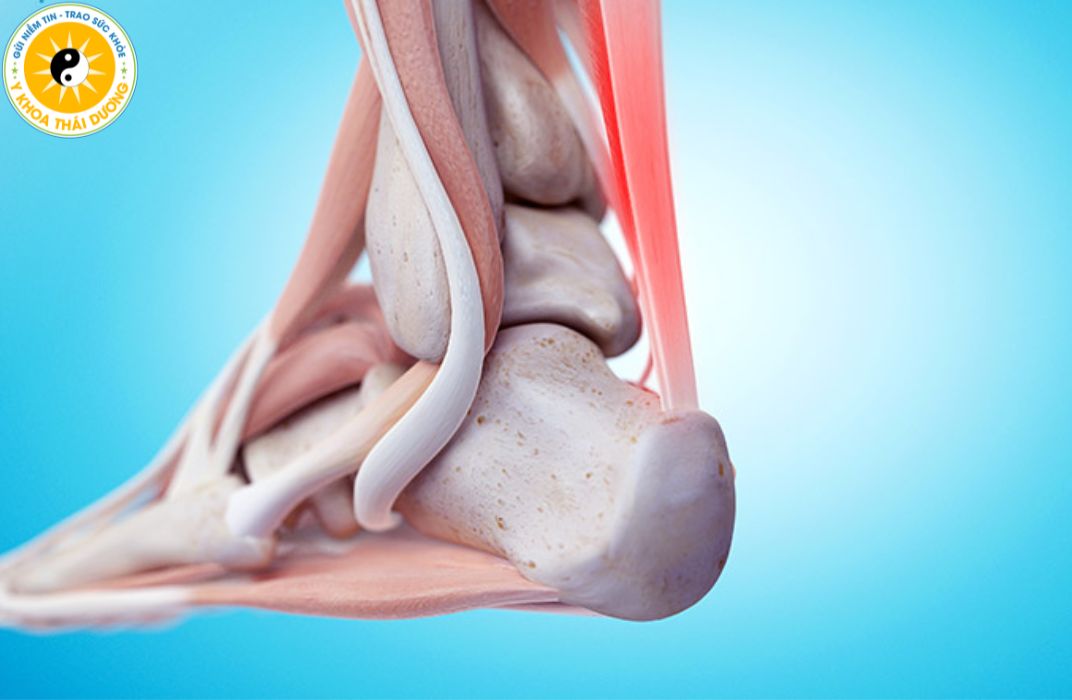 Viêm gân: Làm sao để điều trị dứt điểm và tránh tái phát?