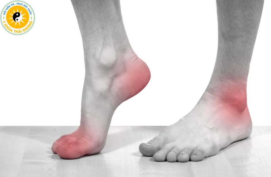 Viêm gân: Làm sao để điều trị dứt điểm và tránh tái phát?