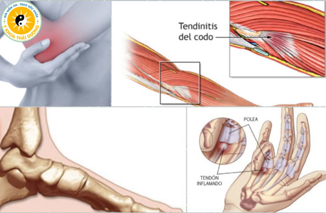 Viêm gân: Nguyên nhân, triệu chứng và phương pháp điều trị