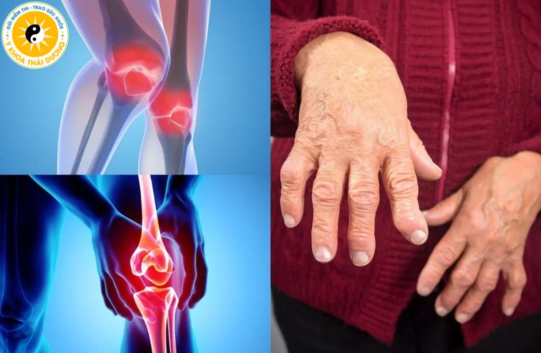 Viêm khớp là gì? Có nên điều trị bằng vật lý trị liệu?