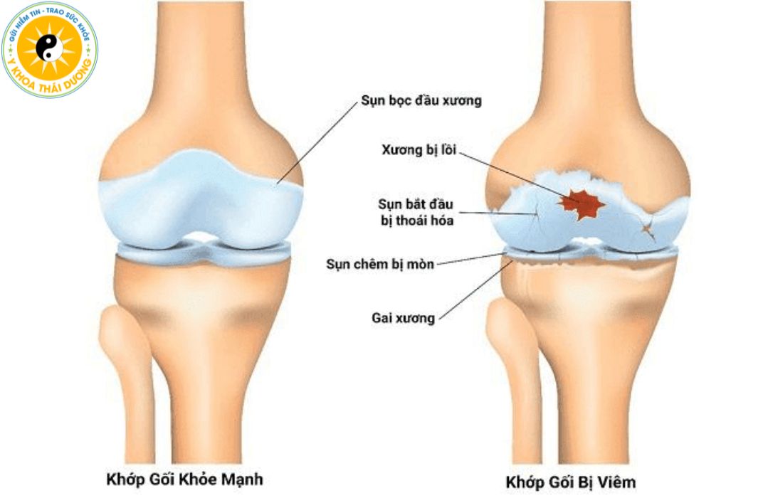 Viêm khớp là gì? Có nên điều trị bằng vật lý trị liệu?