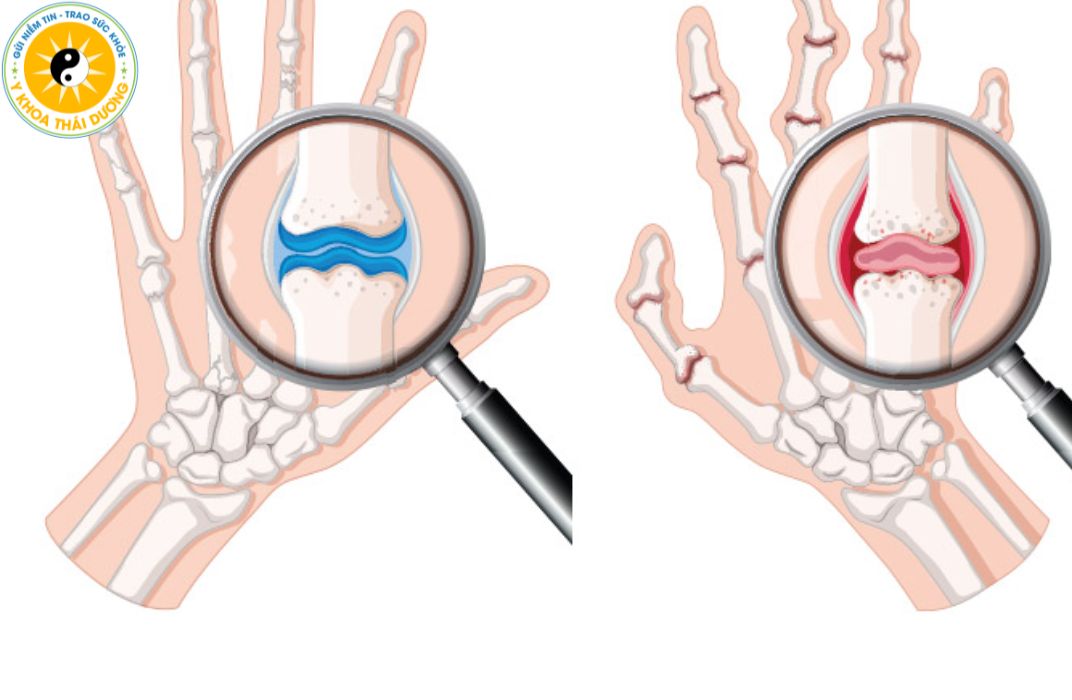Viêm khớp là gì? Có nên điều trị bằng vật lý trị liệu?