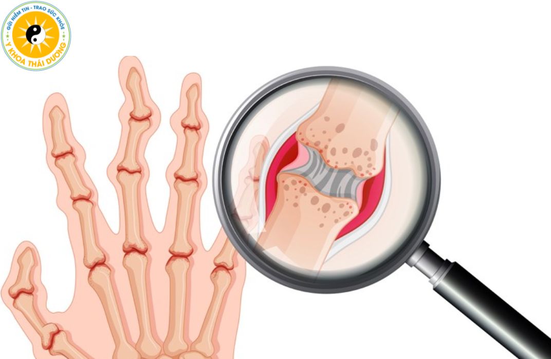 Viêm khớp là gì? Có nên điều trị bằng vật lý trị liệu?