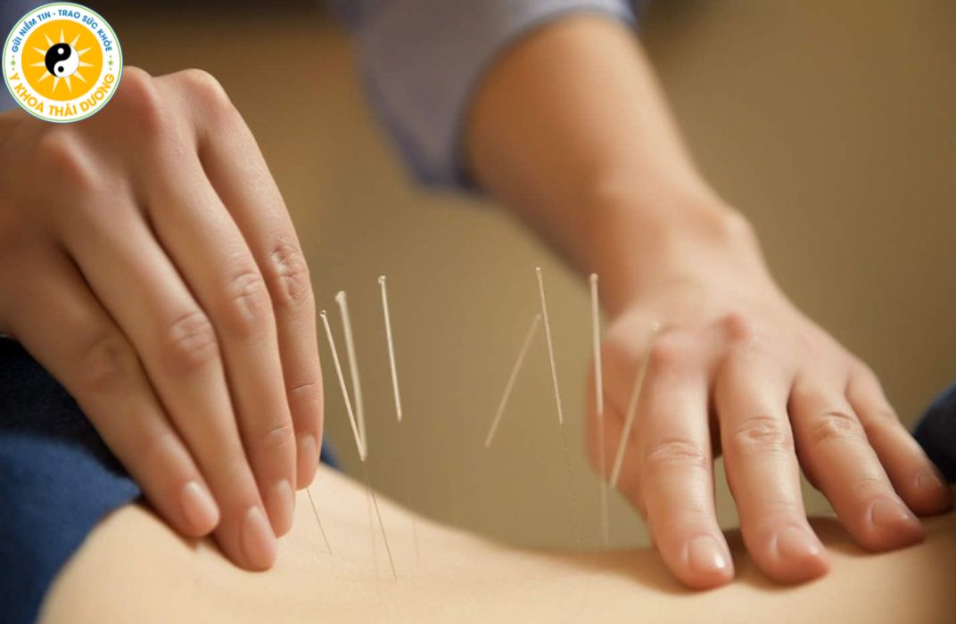 Châm cứu điều trị đau nhức xương khớp có hiệu quả không?
