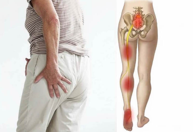 phương pháp điều trị đâu thần kinh tọa