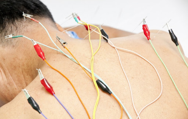 Phương Pháp Châm Cứu Trong Y Học Cổ Truyền: Lợi Ích, Quy Trình Và Những Lưu Ý Quan Trọng 2 image 1